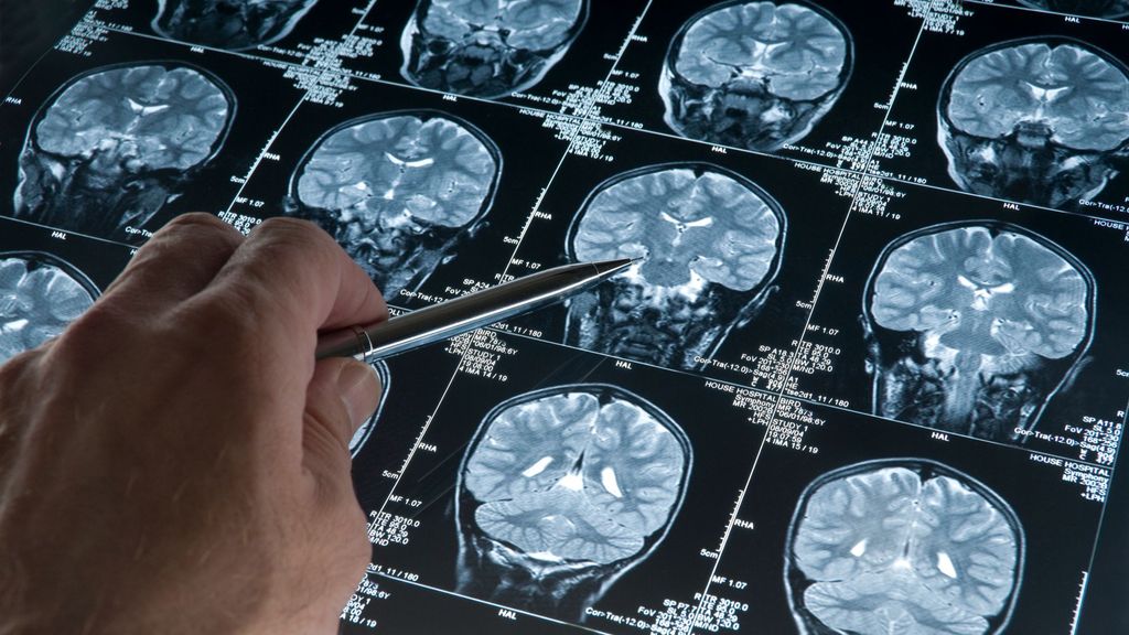 El envejecimiento y las enfermedades neurodegenerativas están asociadas con un aumento de la inflamación cerebral y una disminución de las Tregs