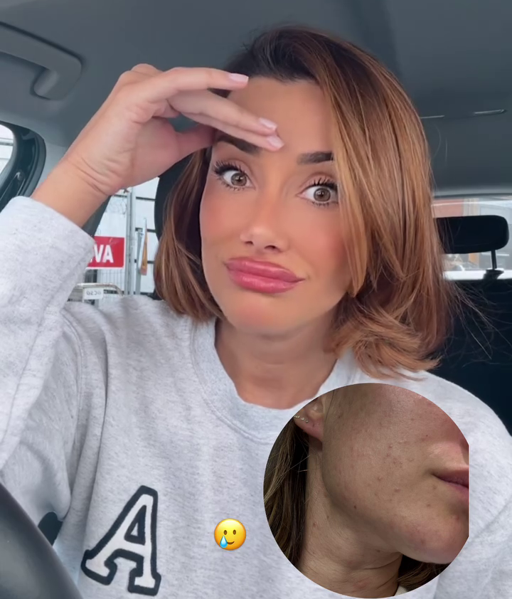 Adara Molinero enseña las secuelas de su problema hormonal