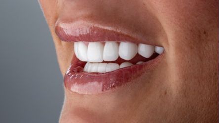 Las carillas de porcelana son las más resistentes y duraderas. FUENTE: Dental&Design