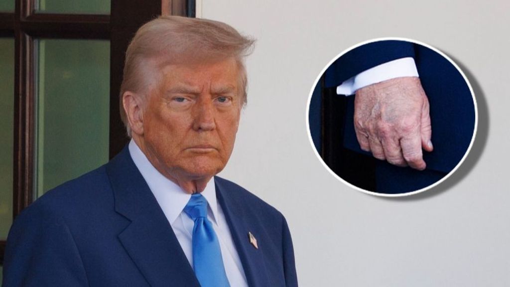 Donald Trump y el hematoma de su mano.