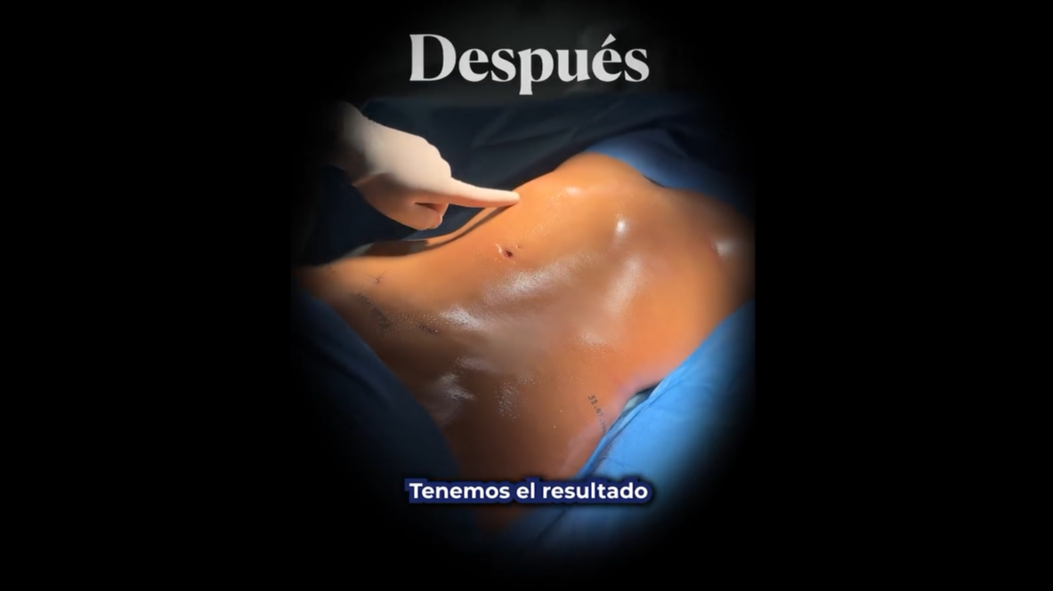 Mayeli: Lipotransferencia de glúteos