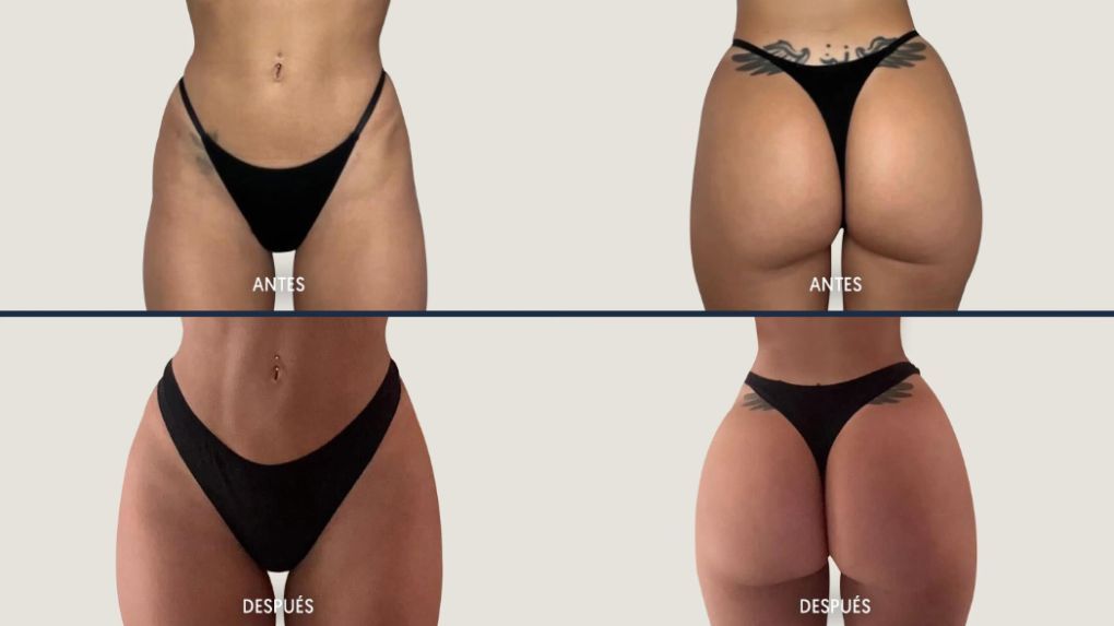 Mónica Bonilla: Cambio radical con tres cirugías simultáneas