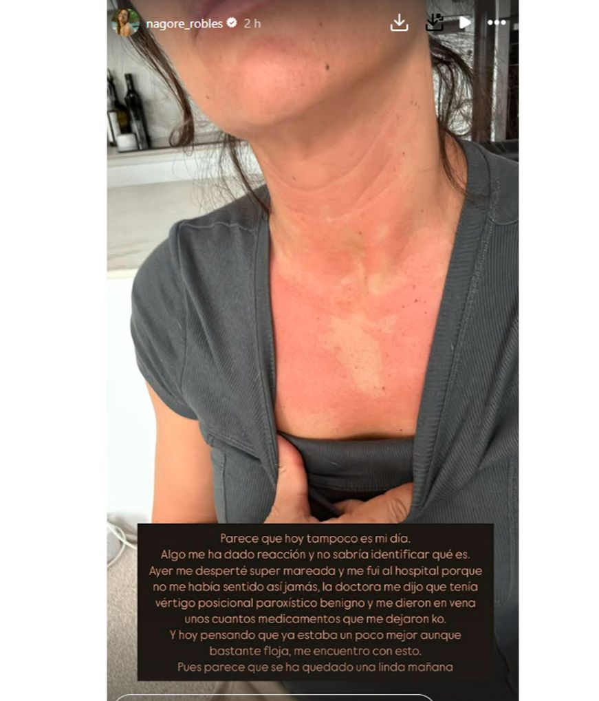 Nagore Robles muestra la fuerte erupción que le ha salido en la piel tras acabar anteriormente en el hospital