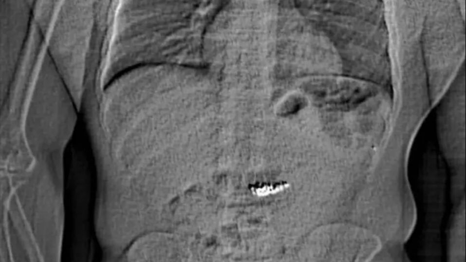 Radiografía del ladrón que se tragó unos pendientes valorados en 700.000 euros