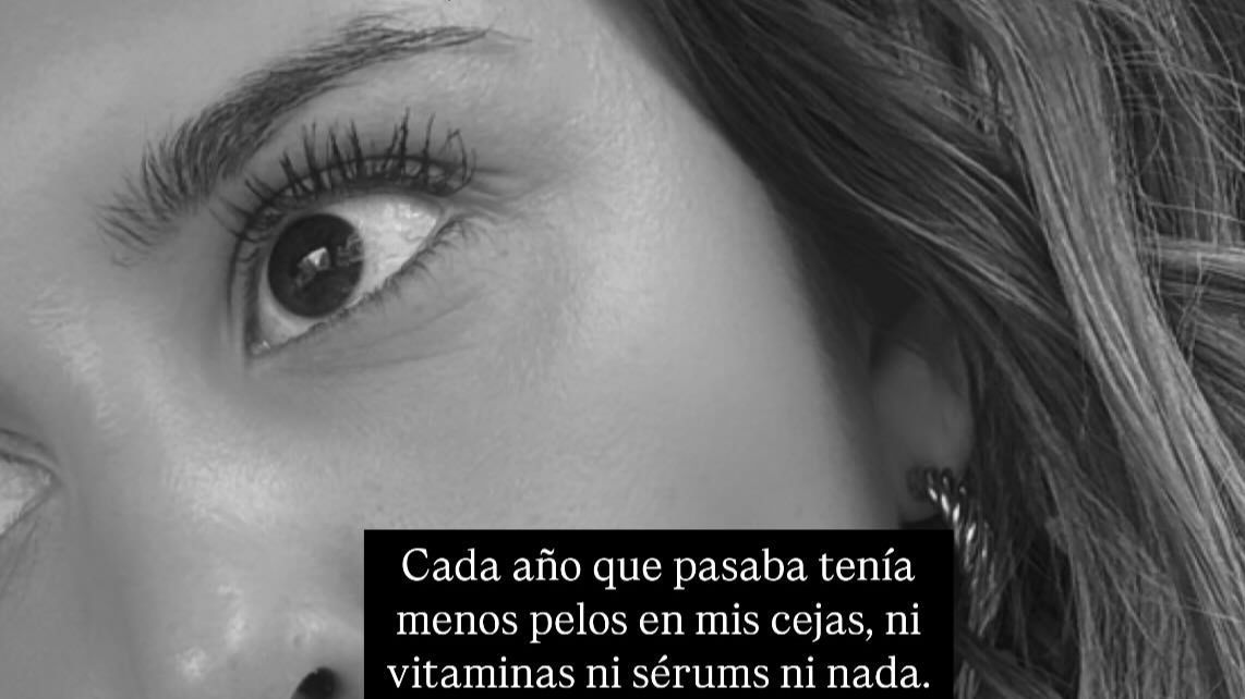 Marina enseña sus "calvas" y asegura que su "problema" estaba empeorando con los años