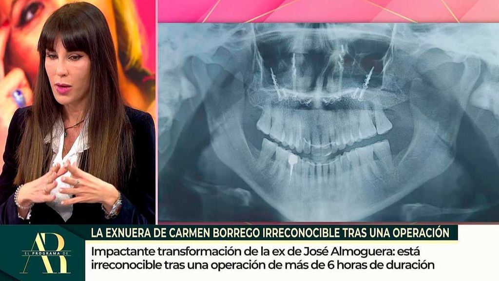 Los detalles de la operación de Paola Omedo: muy dolorosa y con un postoperatorio muy largo