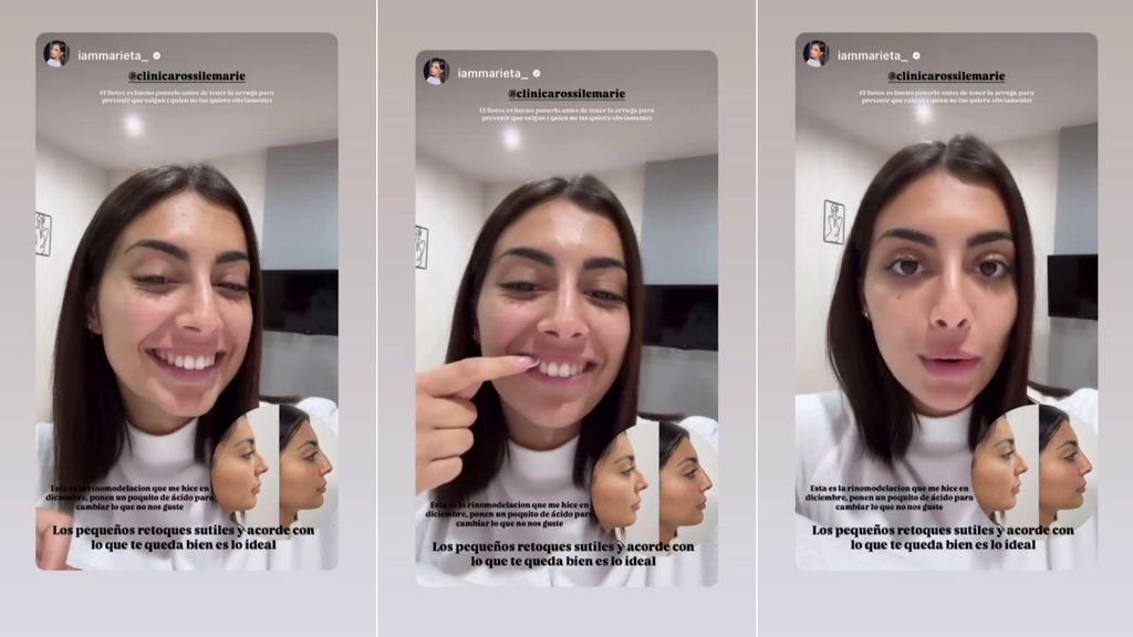Marieta enseña sus labios más finos y sus nuevos retoques estéticos