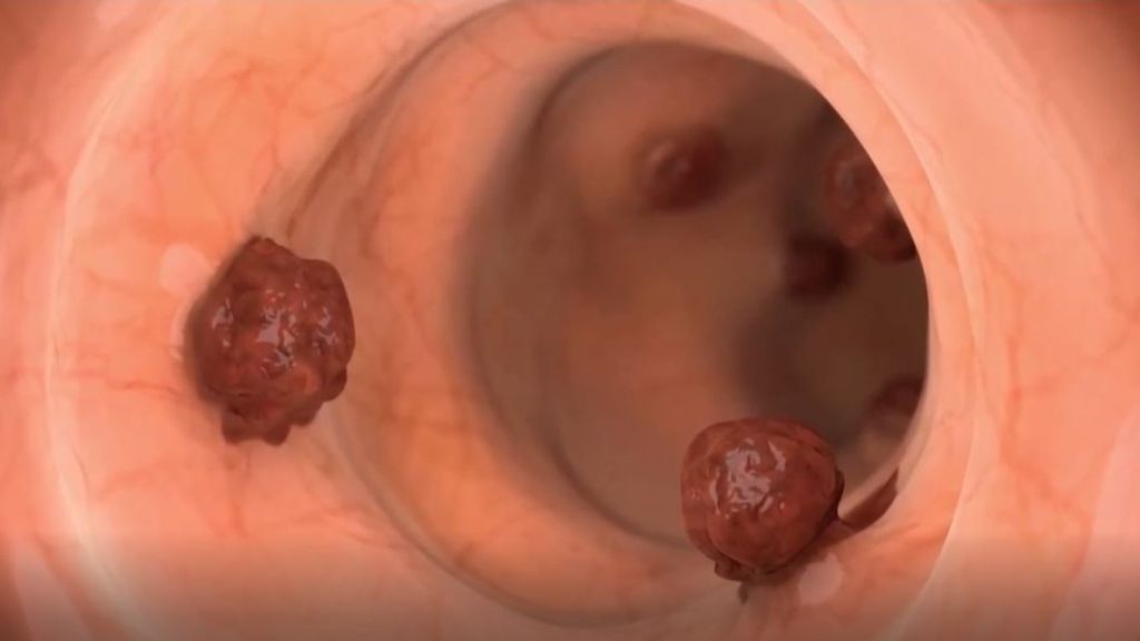 El cáncer de colon, un tumor que podemos provocarnos nosotros mismos
