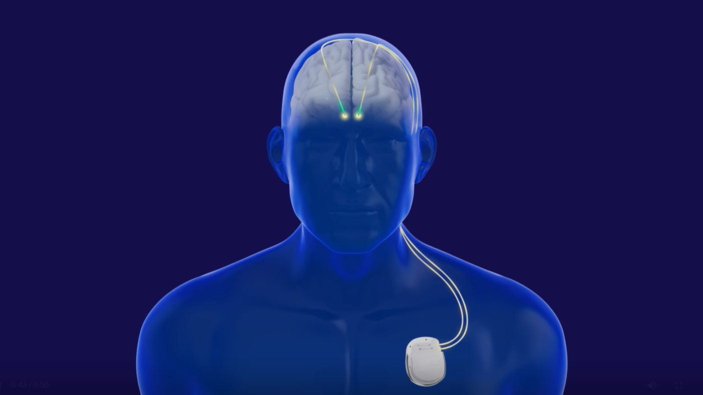 El Hospital Gregorio Marañón ha sido el primer centro público en España en aplicar una cirugía adaptativa frente al Parkinson