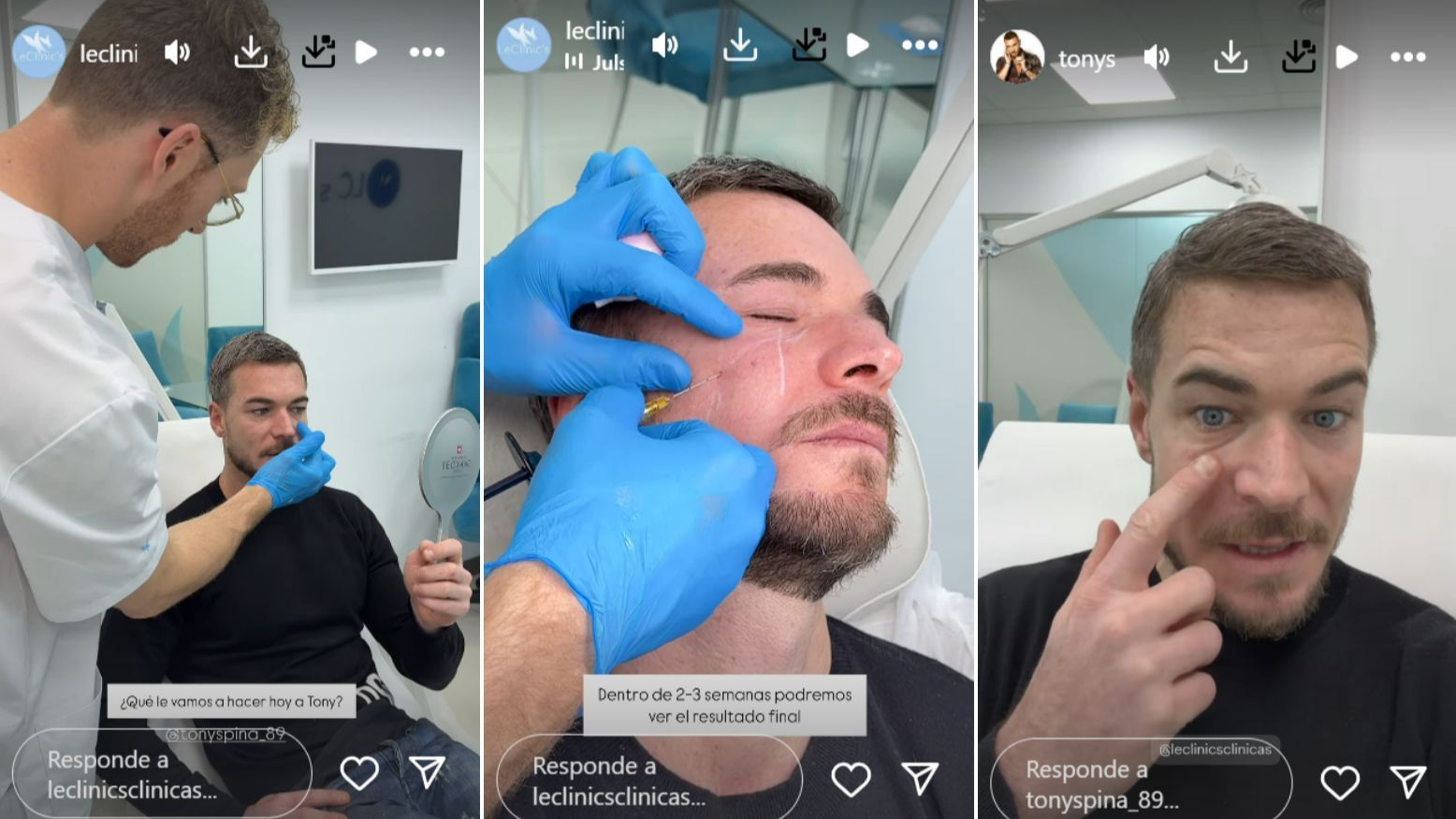 Tony Spina se ha sometido a un retoque estético para quitarse el surco de la ojera