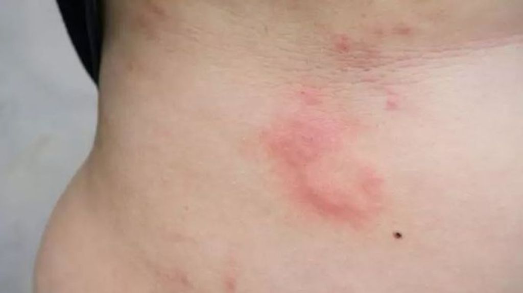 Alergia por estrés: síntomas y cómo podemos combatirla