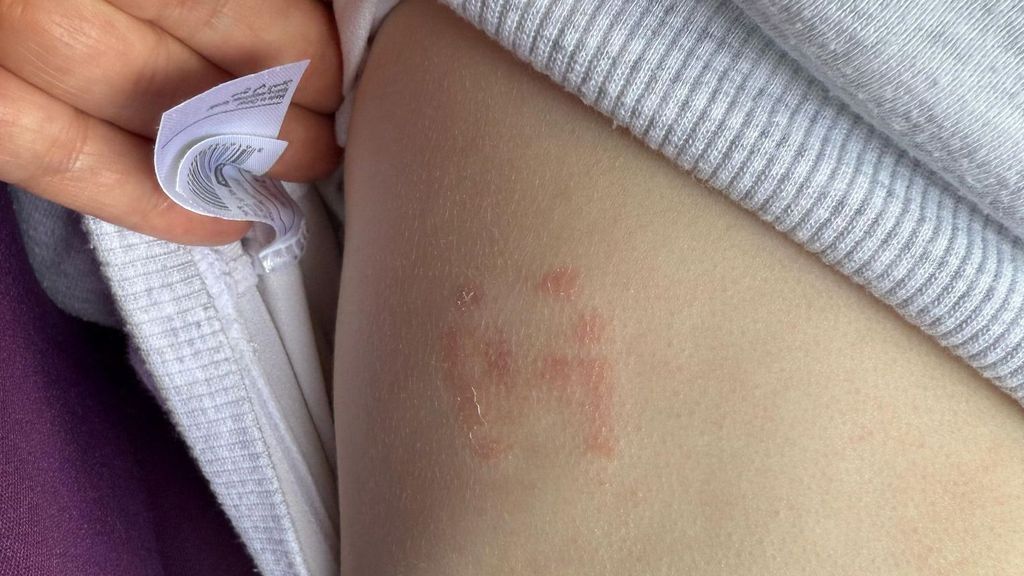 Herida producida por otro niño del centro