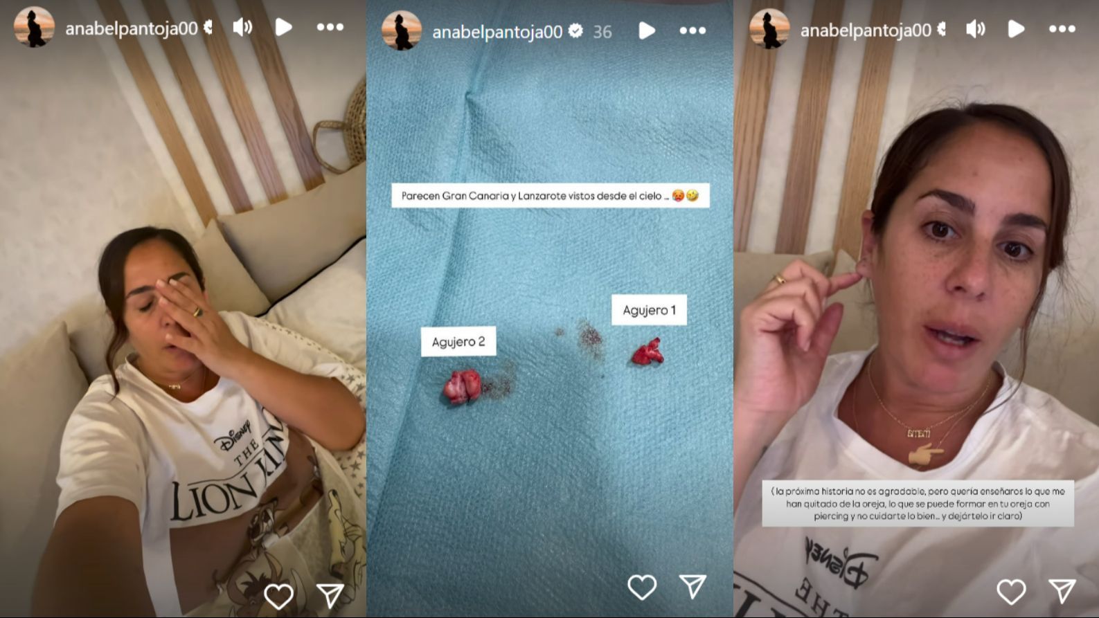 Anabel Pantoja muesta los quistes que le han extraído y cómo le ha quedado la oreja