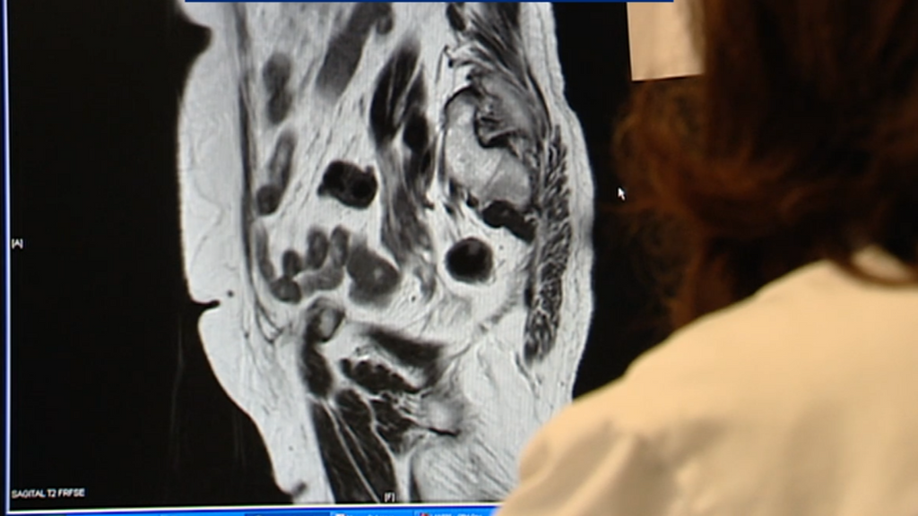 El aumento de cáncer de colon en jóvenes podría ser por la infección con una bacteria en la infancia
