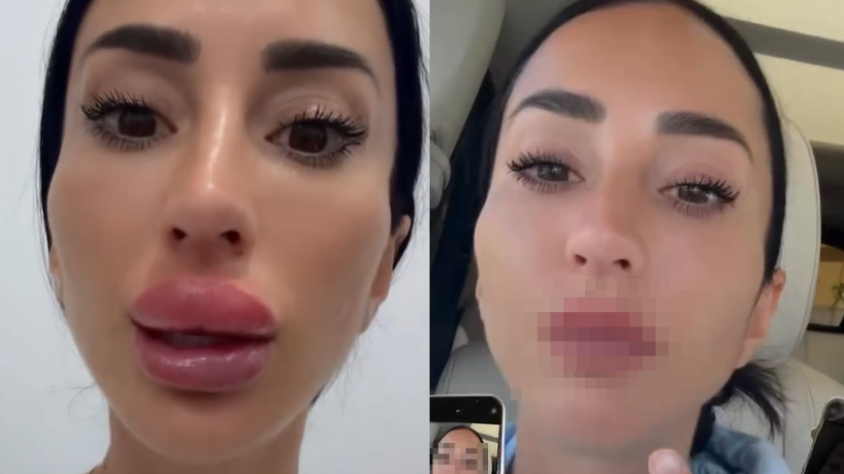 Aurah Ruiz se quita el ácido hialurónico de los labios y enseña el resultado
