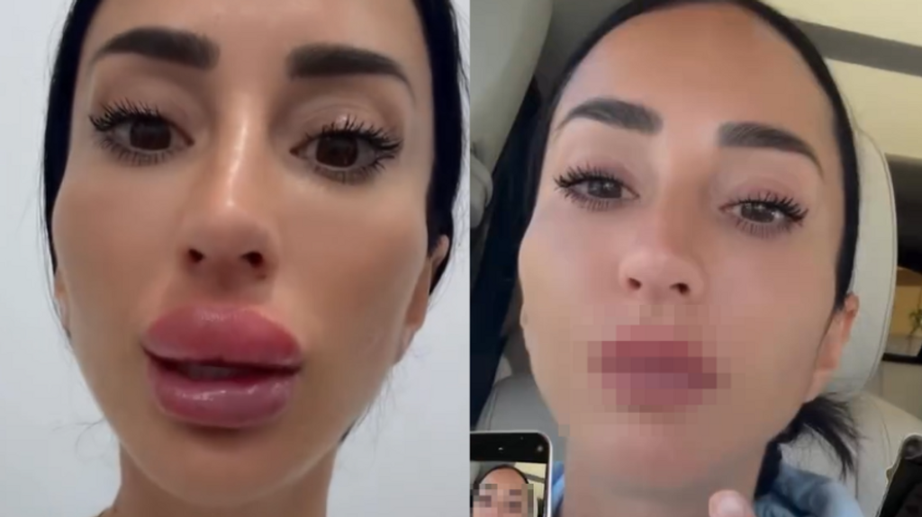 Aurah Ruiz se quita el ácido hialurónico de los labios y enseña el resultado