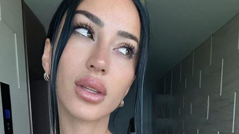 Aurah Ruiz se retira el ácido de los labios y enseña el resultado