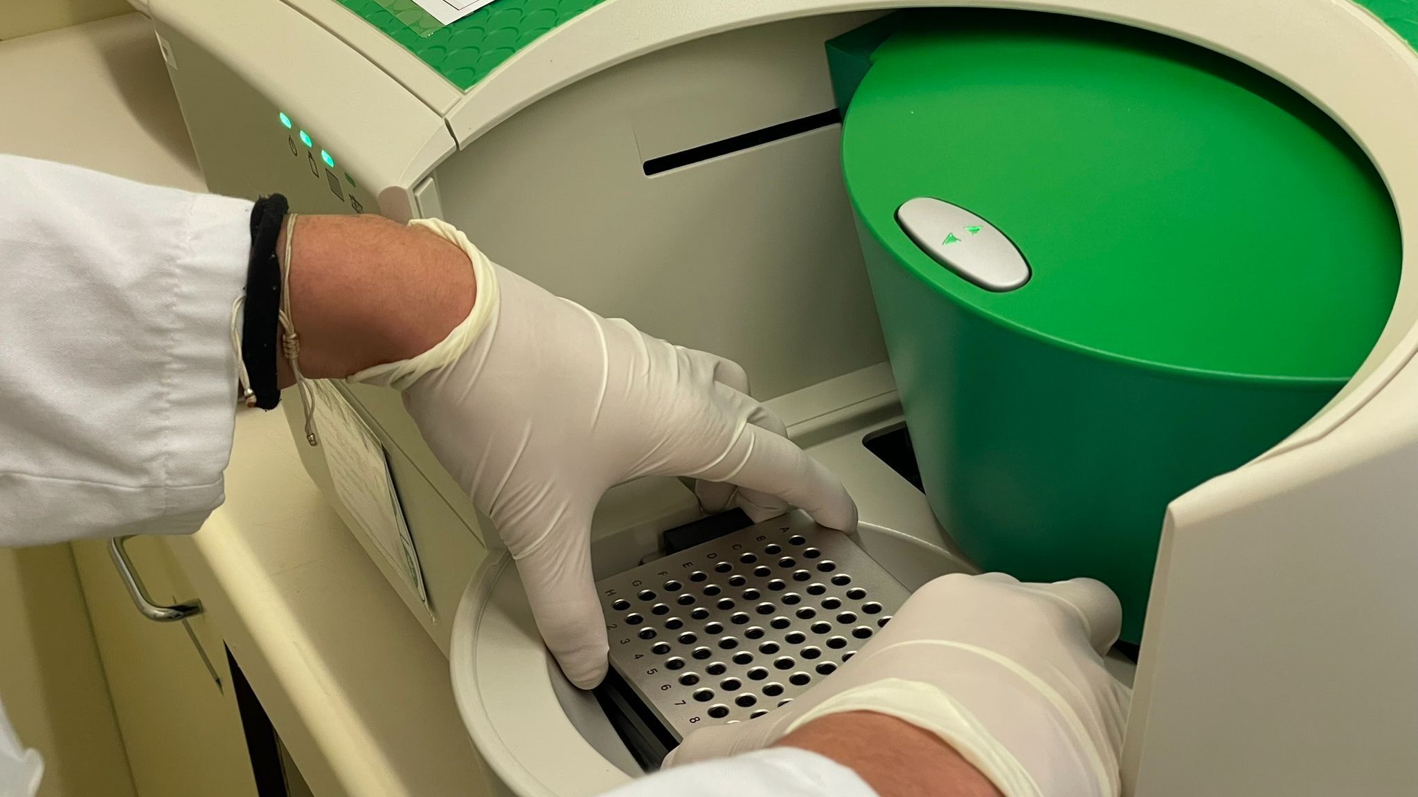 Una mutación genética de 7.000 años de antigüedad protege contra el VIH: "Las personas sobrevivían mejor"