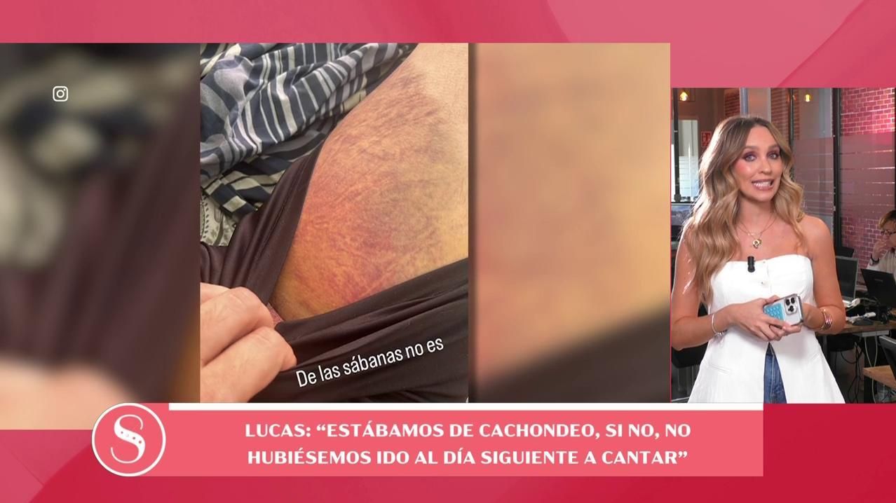 El moratón de Andy tras lo sucedido en el camerino