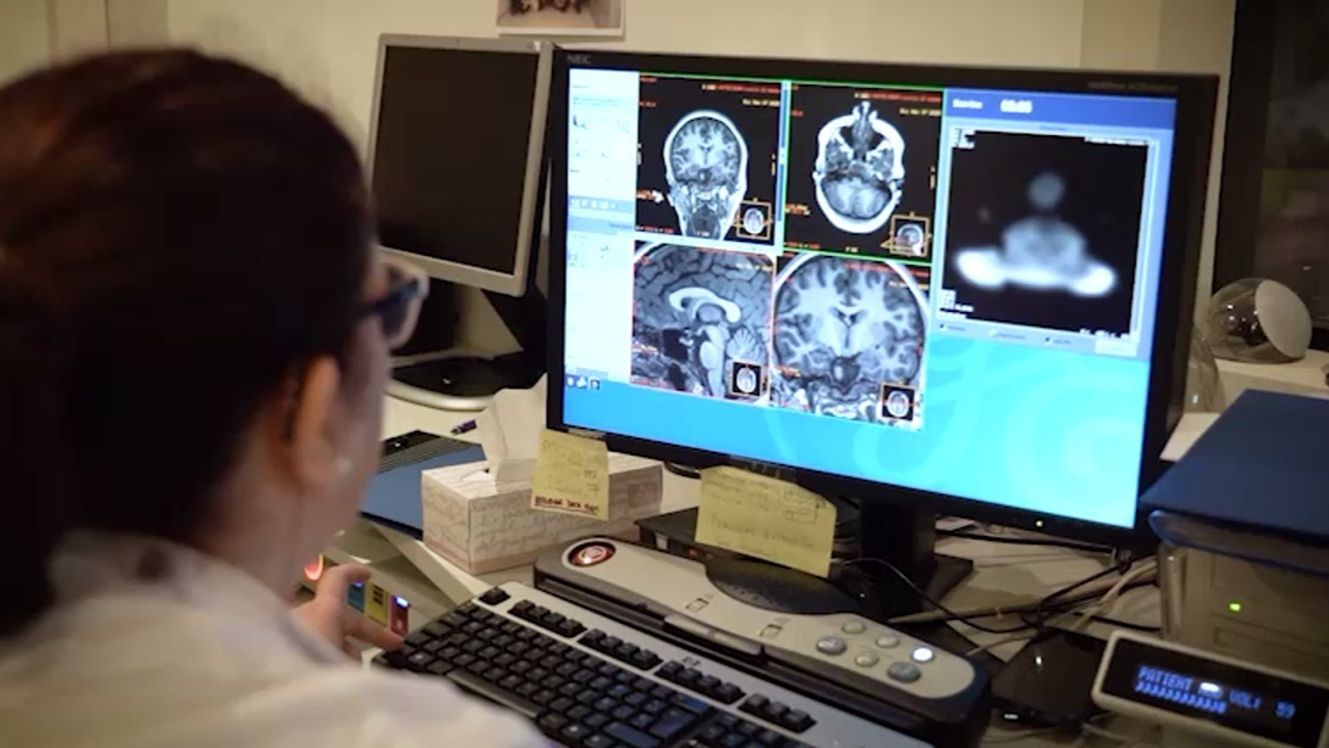 Un estudio confirma que el lecanemab es seguro en pacientes con alzhéimer: "Los efectos son manejables"