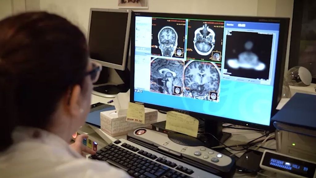 Un estudio confirma que el lecanemab es seguro en pacientes con alzhéimer: "Los efectos son manejables"