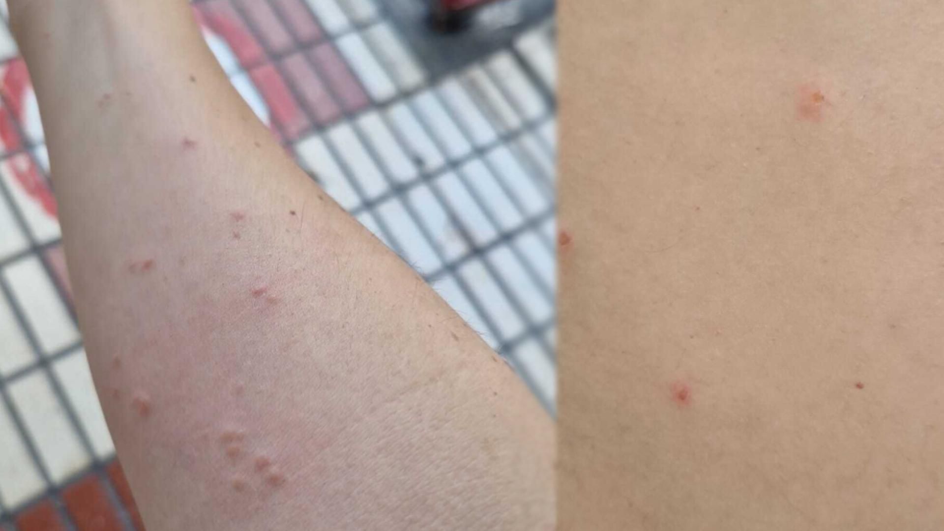 Uno de los sanitarios afectado por las picaduras