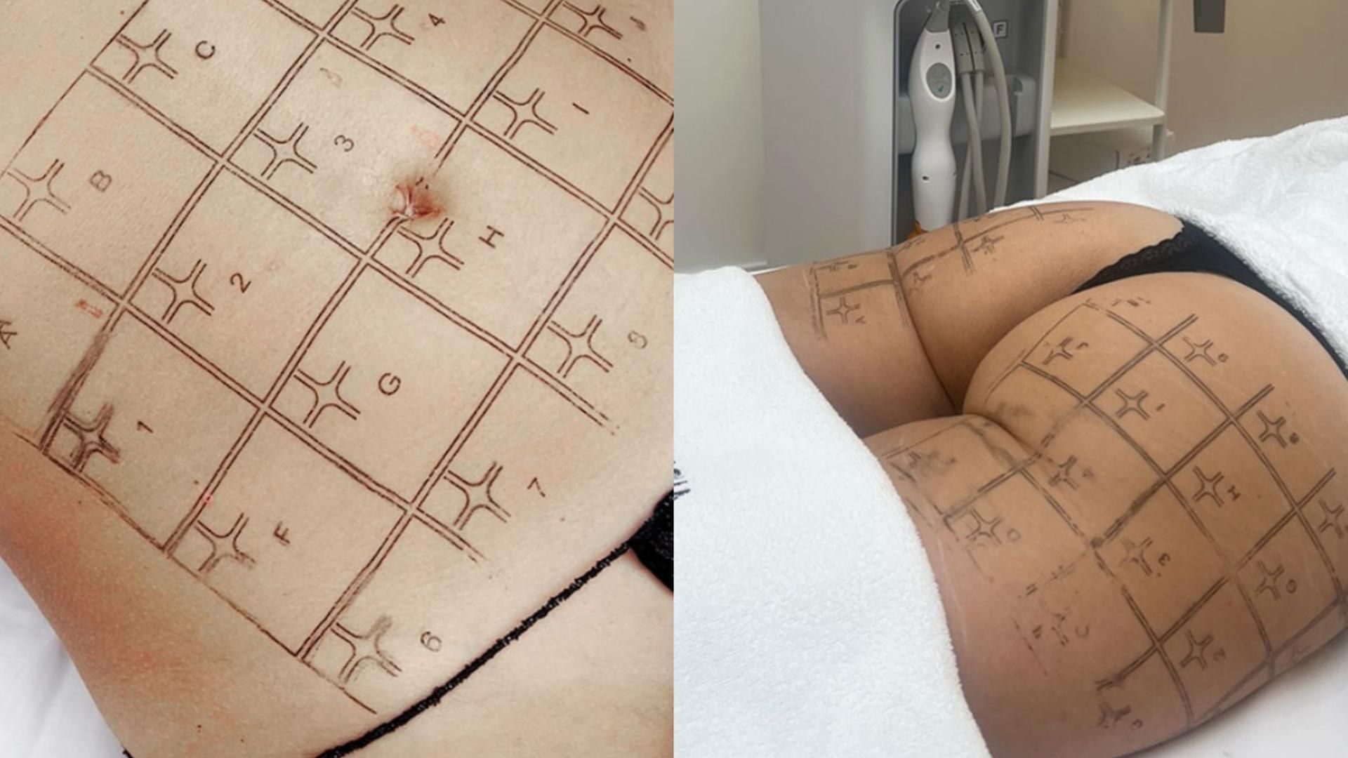 Fotomontaje del tratamiento 'Thermage' en abdomen y glúteos