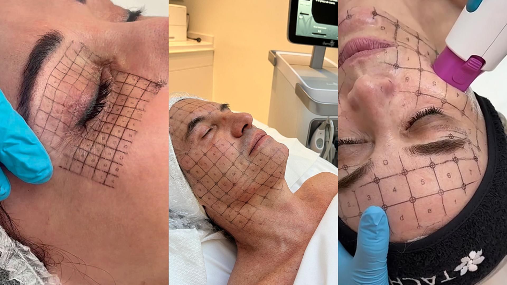 Fotomontaje del tratamiento 'Thermage' en el rostro