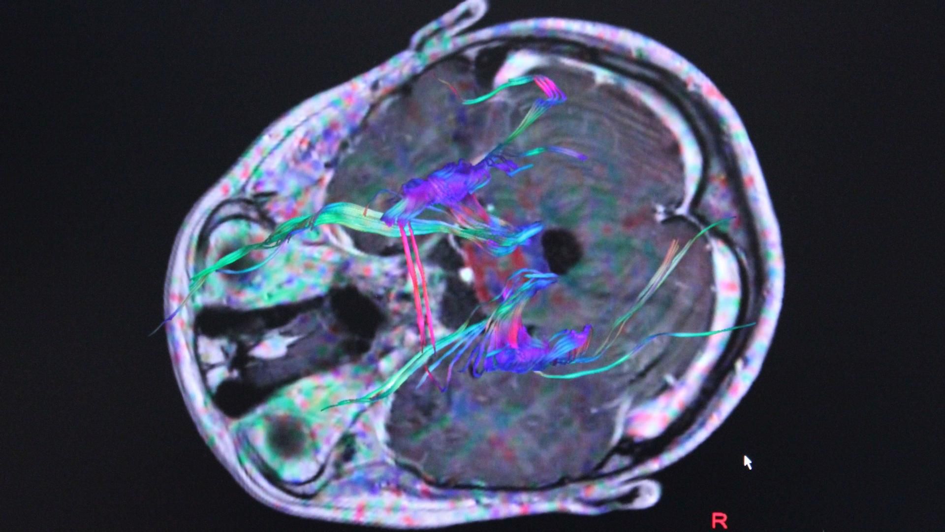 Imagen de un escáner del cerebro