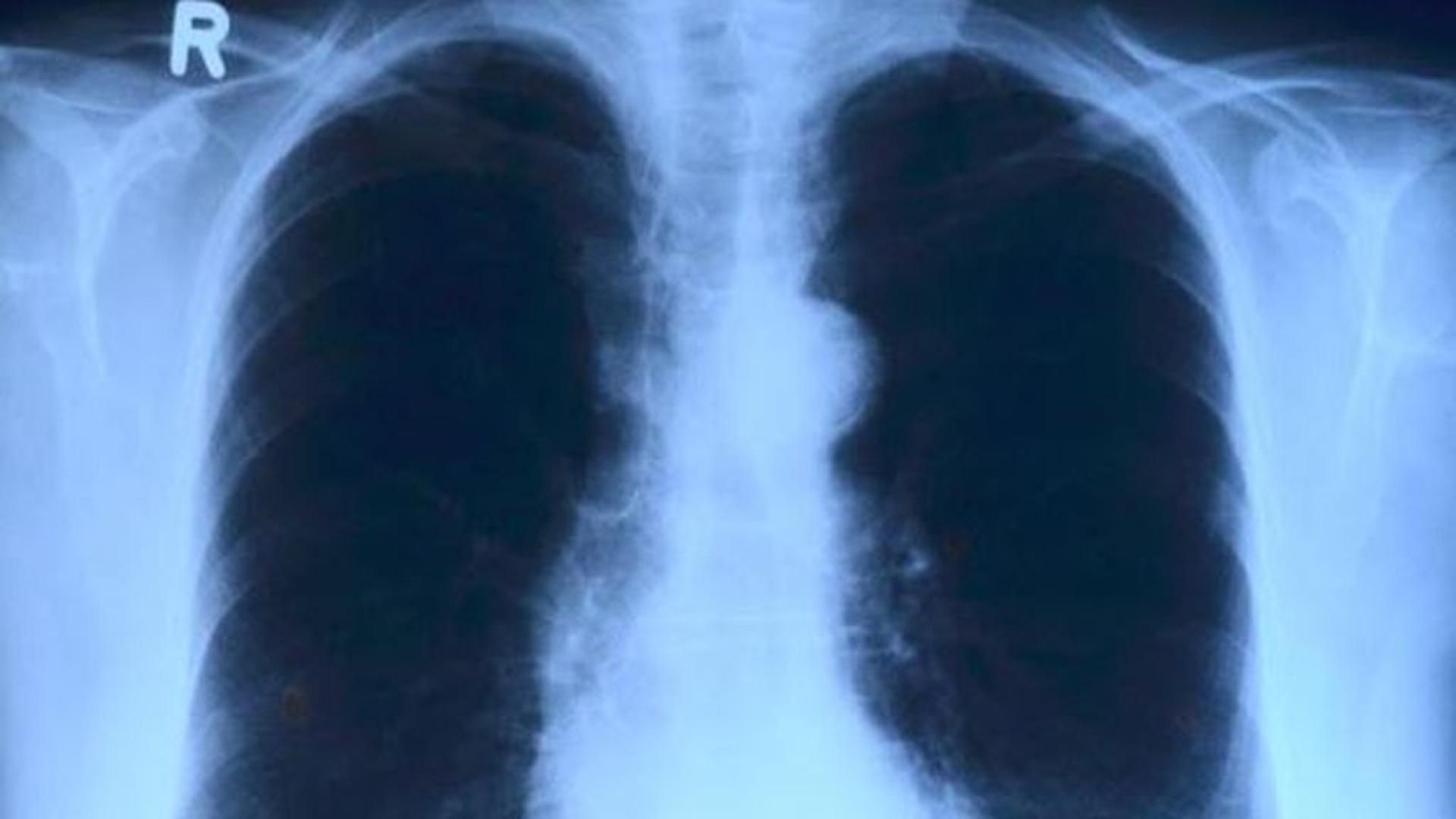 pulmones