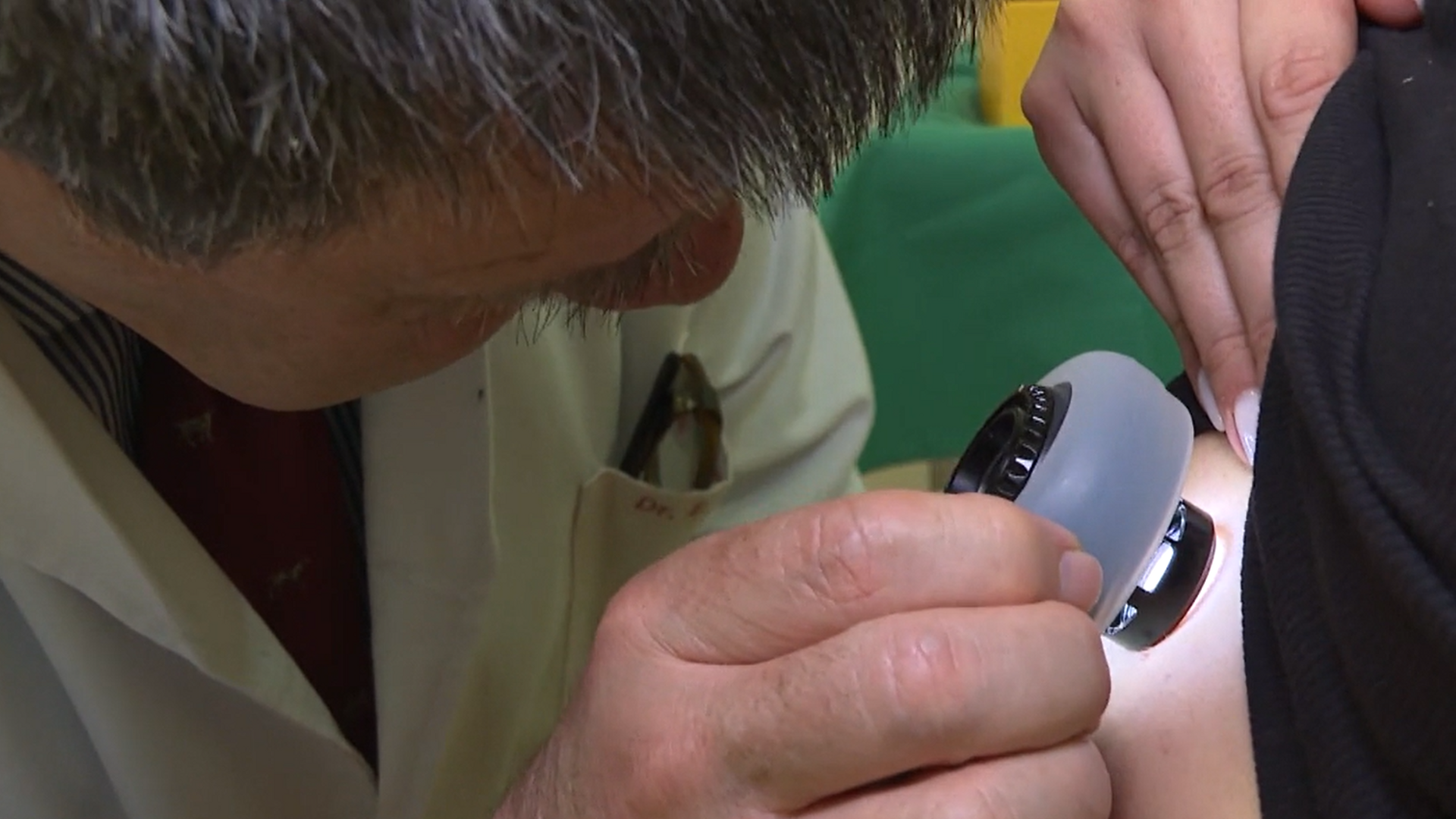 Cómo podemos prevenir el melanoma, el tumor de piel más agresivo