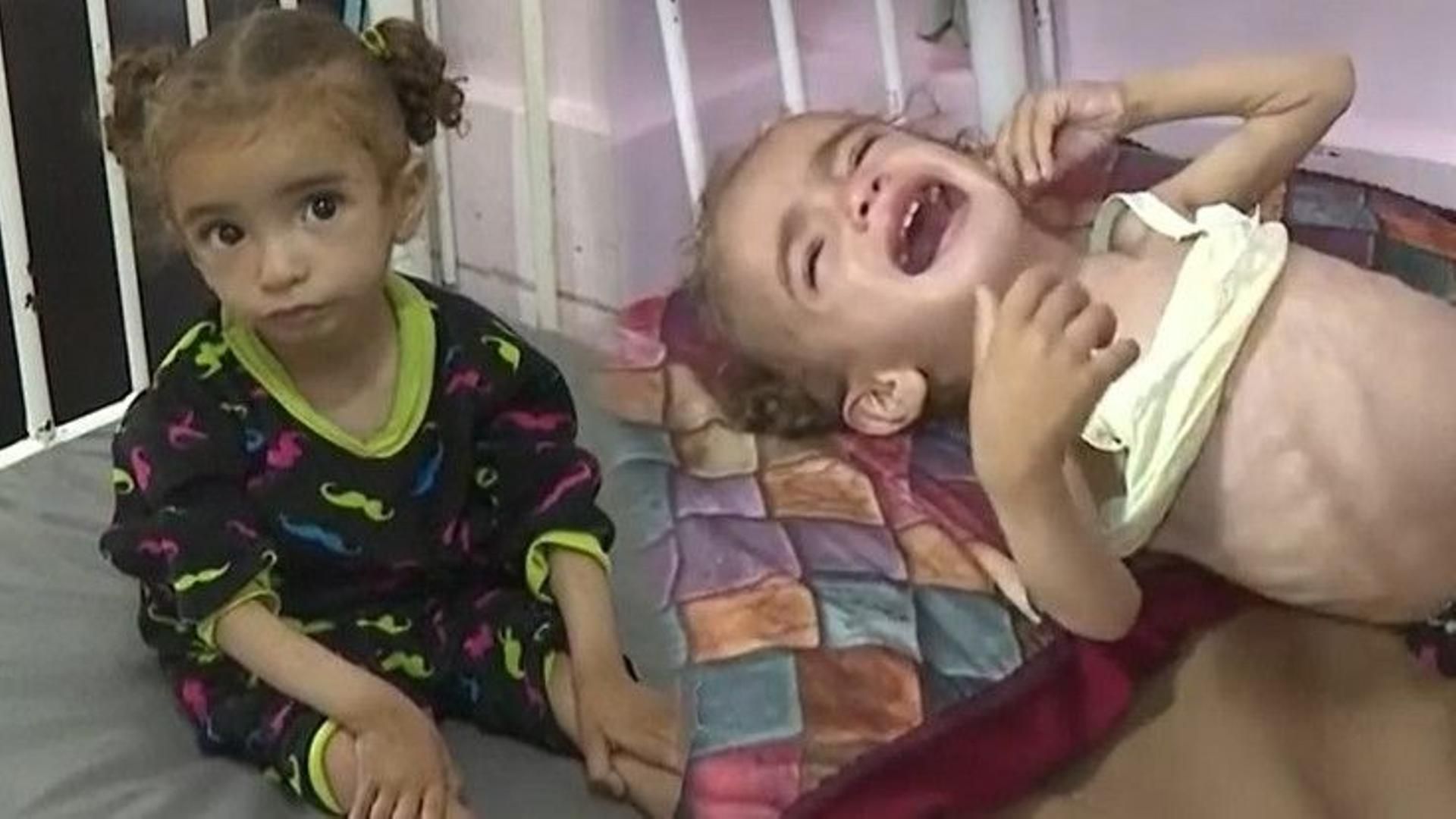 Mayar, una de las niñas que sufre la preocupante desnutrición en Gaza: "Tiene dos años, es celiaca y sufre diarrea crónica"