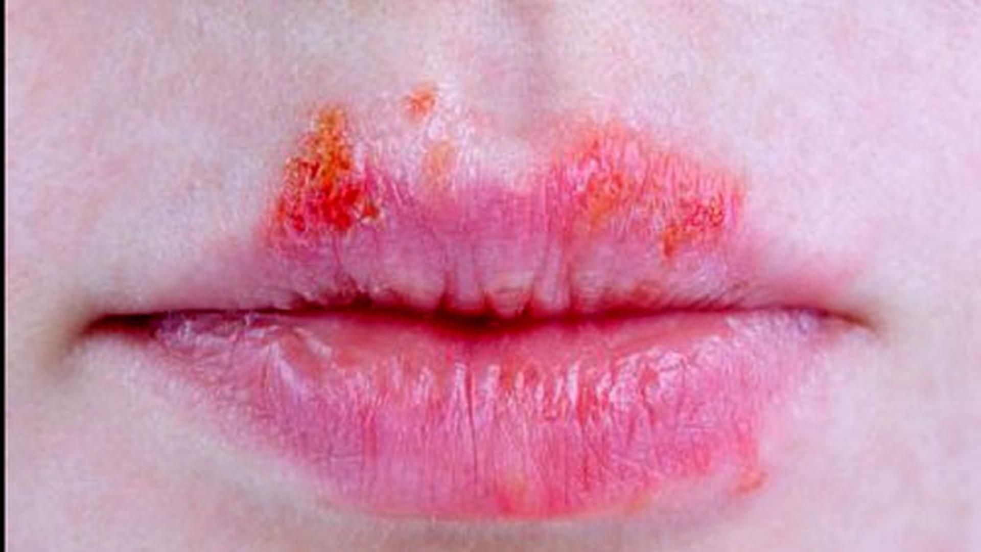 herpes labial y genital,herpes orolabial,virus del herpes herpes labial y genital,herpes orolabial,virus del herpes