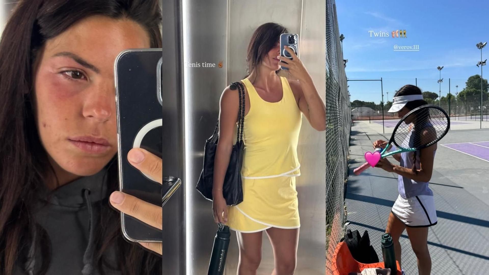 Laura Matamoros enseña su cara 'desfigurada' por un reacción alérgica