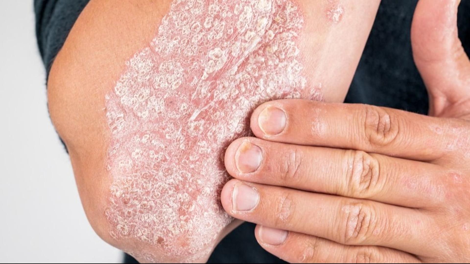 Persona con psoriasis en brazo