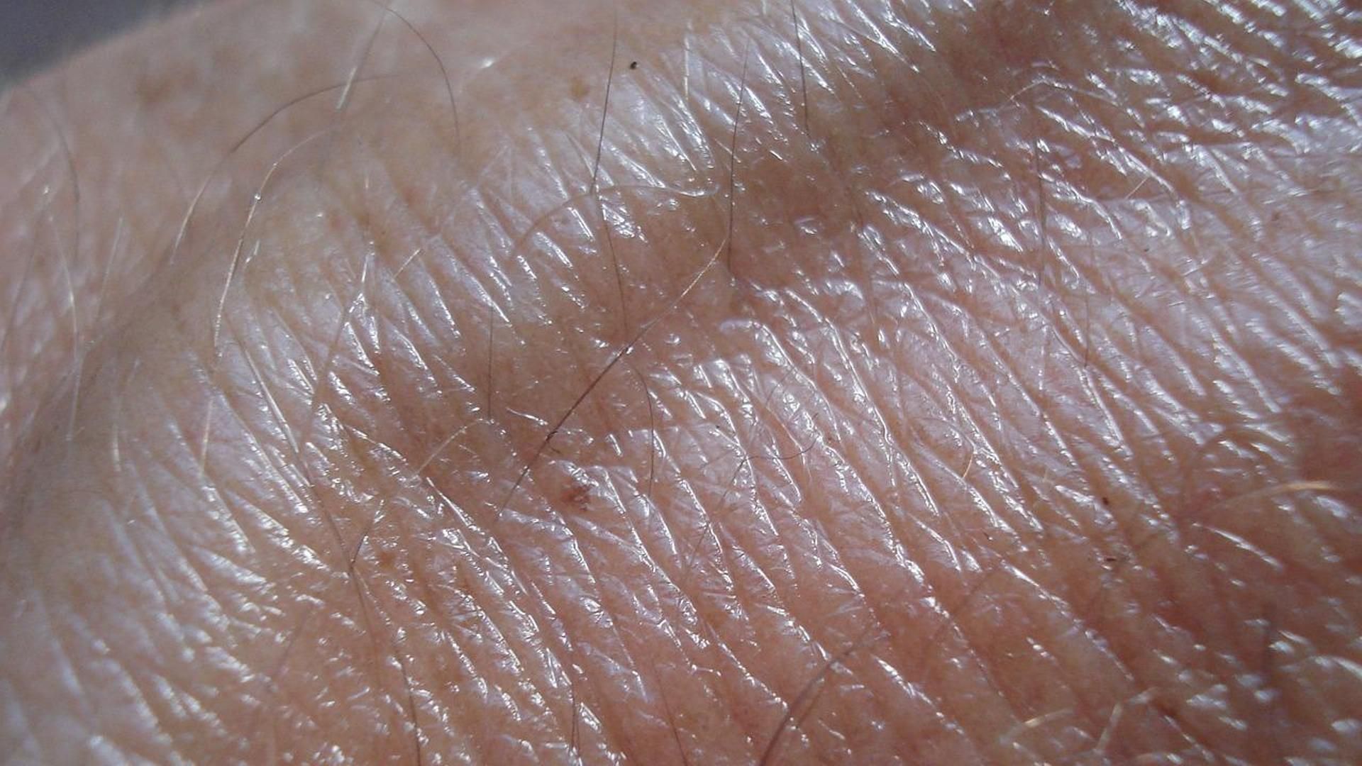 El cáncer de piel aparece cuanto más nos exponemos al sol