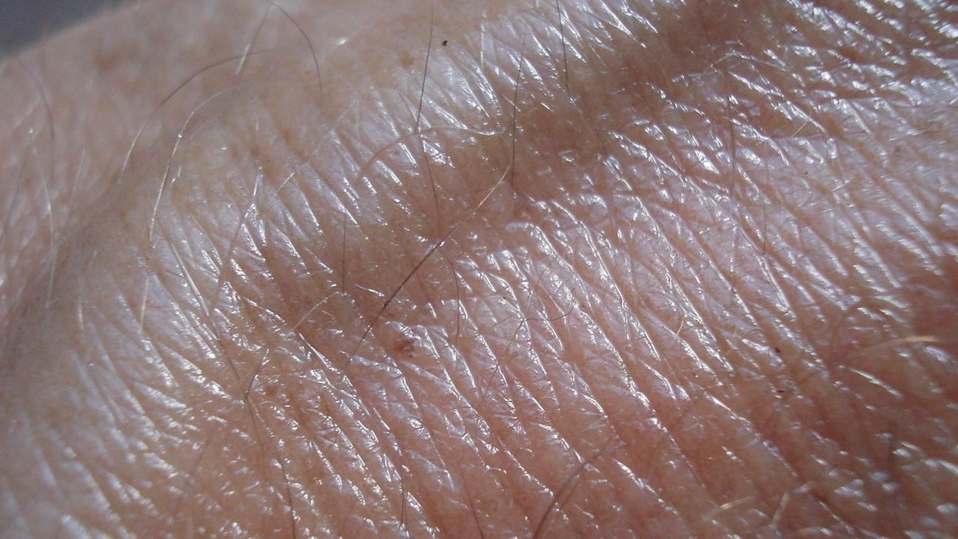 El cáncer de piel y su diferente prevalencia según el sexo: los hombres lo tienen en el pecho