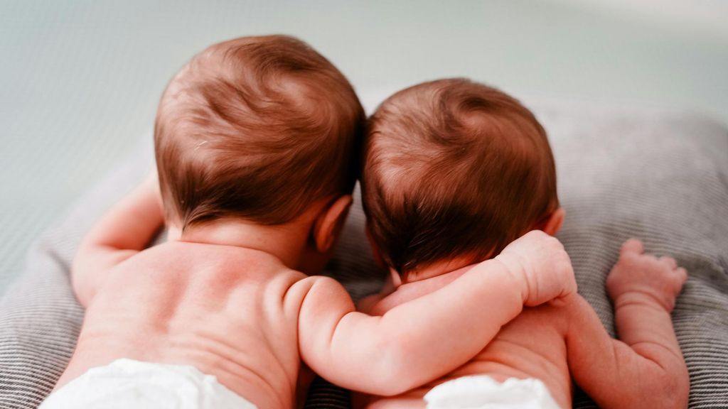 11 bebés con el síndrome del hombre lobo: sus padres usaban lociones para la calvicie