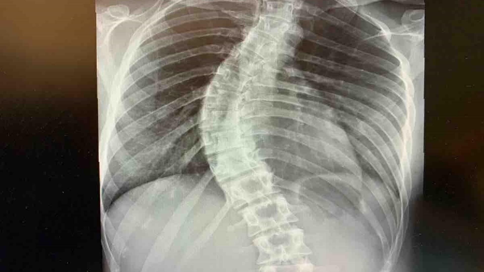 Un estudio sugiere que los pacientes con escoliosis idiopática adolescente presentan mayores anomalías visuales