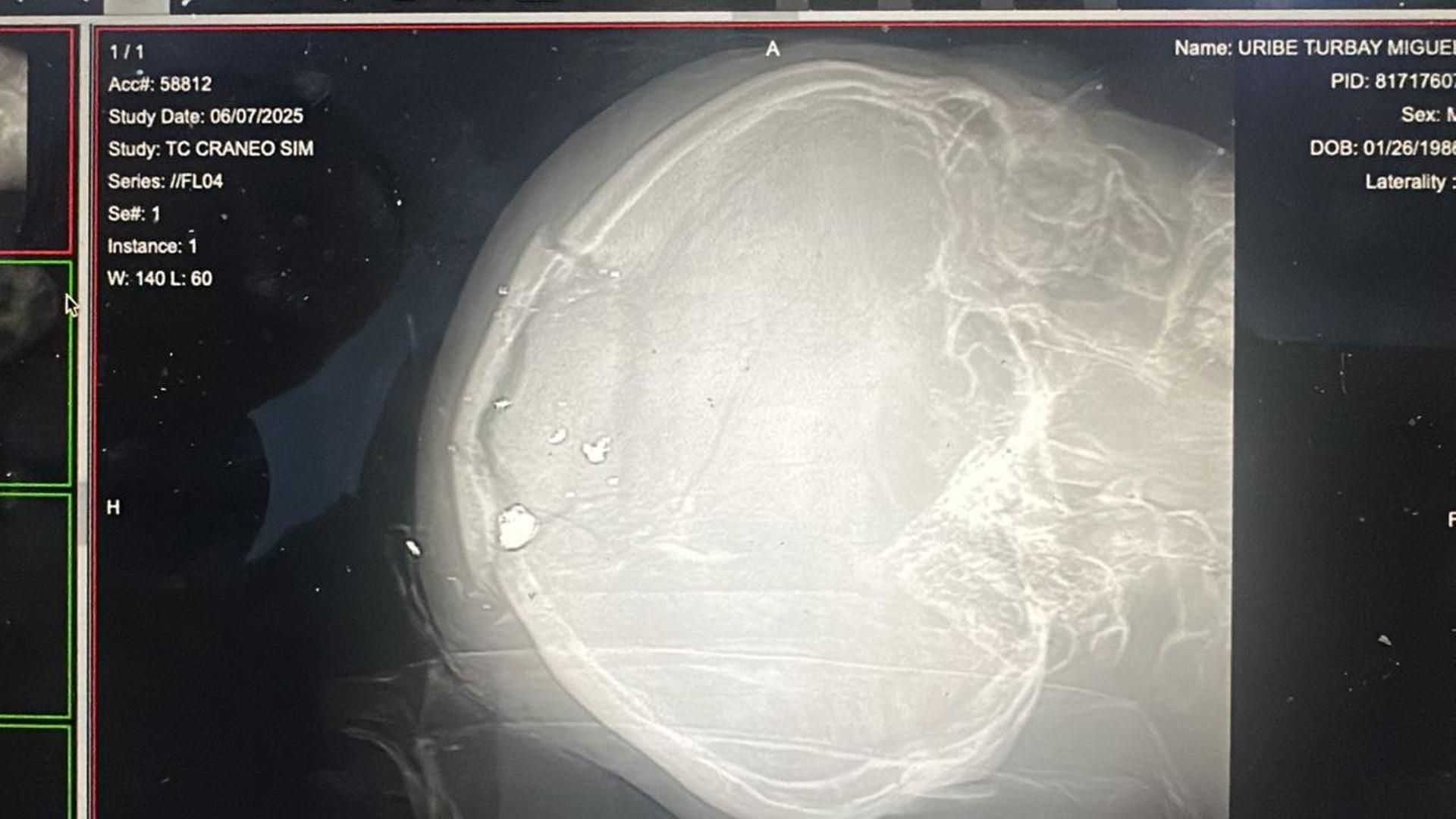 La radiografía de Miguel Uribe: así quedó su cráneo tras recibir dos disparos durante un mitin en Colombia