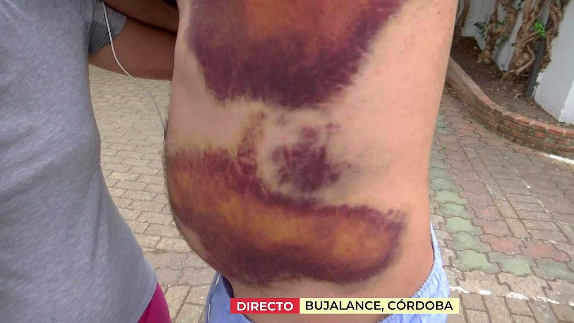 Los moratones que tiene el marido de Eloísa tras recibir una paliza
