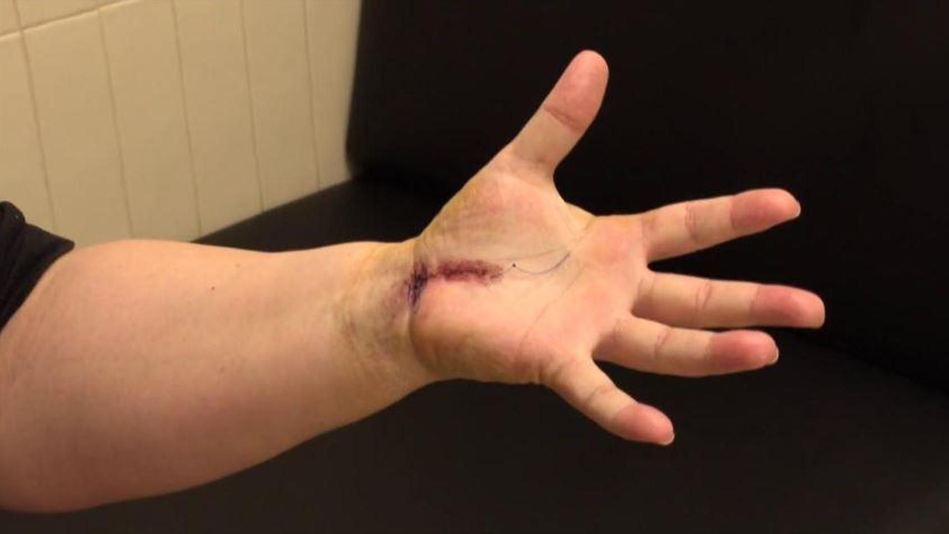 Realizan una operación pionera contra la atrofia de Sudeck: "con aquel dolor era mejor no vivir"