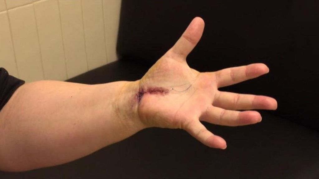 Realizan una operación pionera contra la atrofia de Sudeck: "con aquel dolor era mejor no vivir"