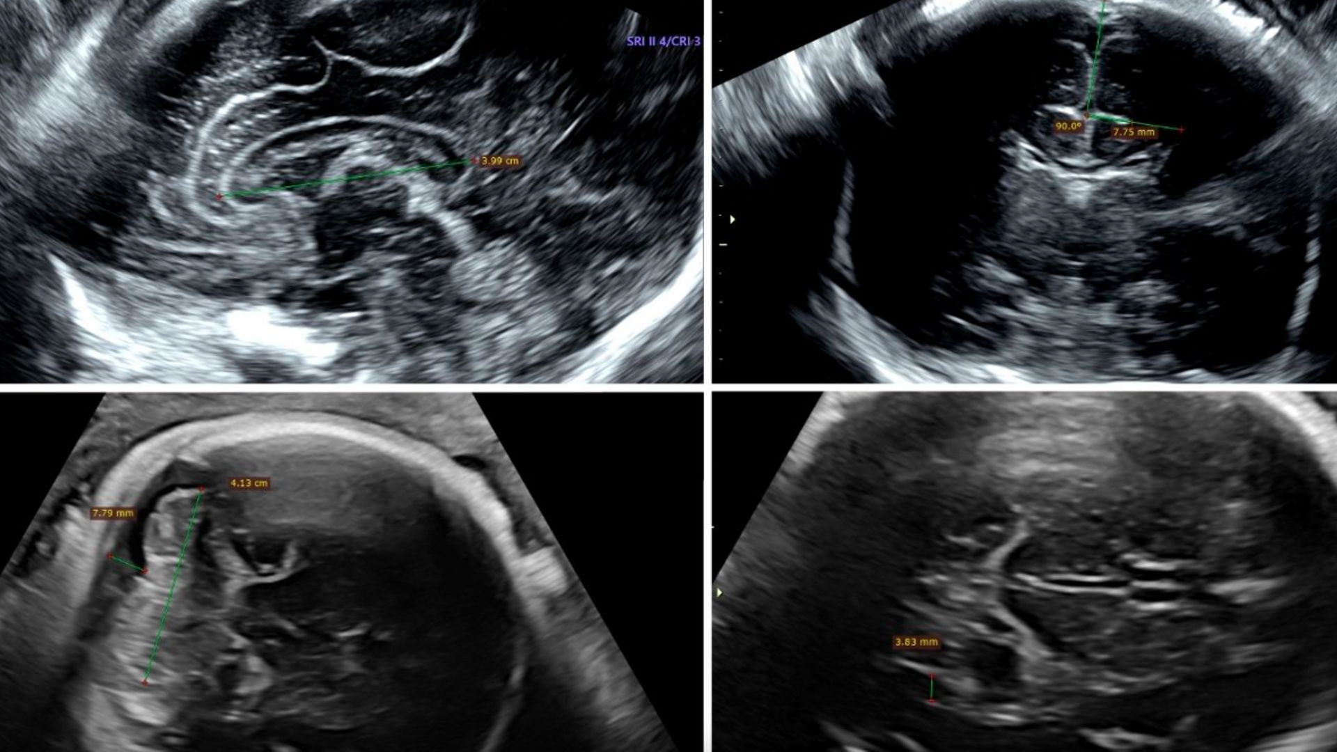 Imagen de una neurosonografía transvaginal