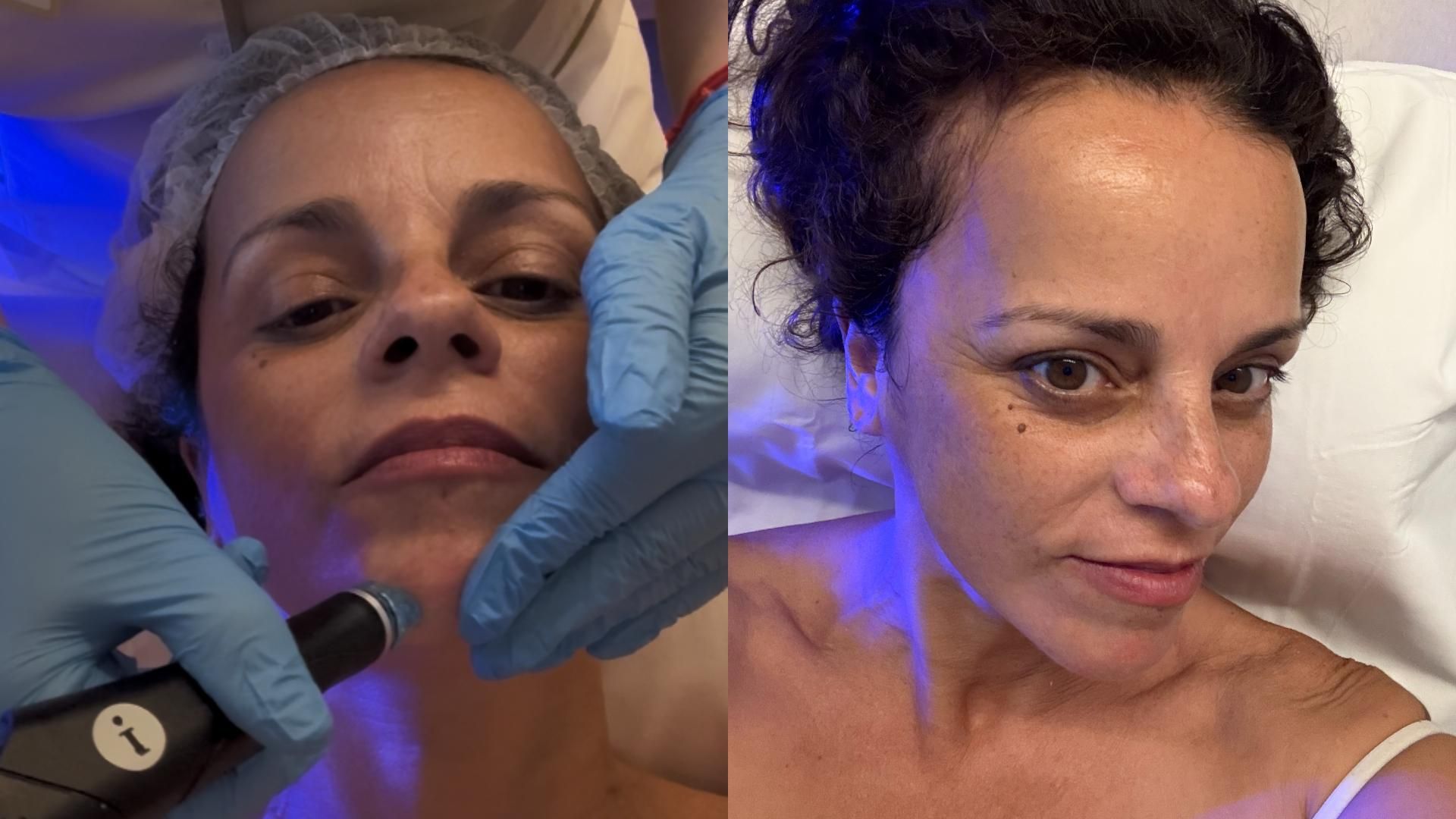 Cara de Paka antes y después del tratamiento