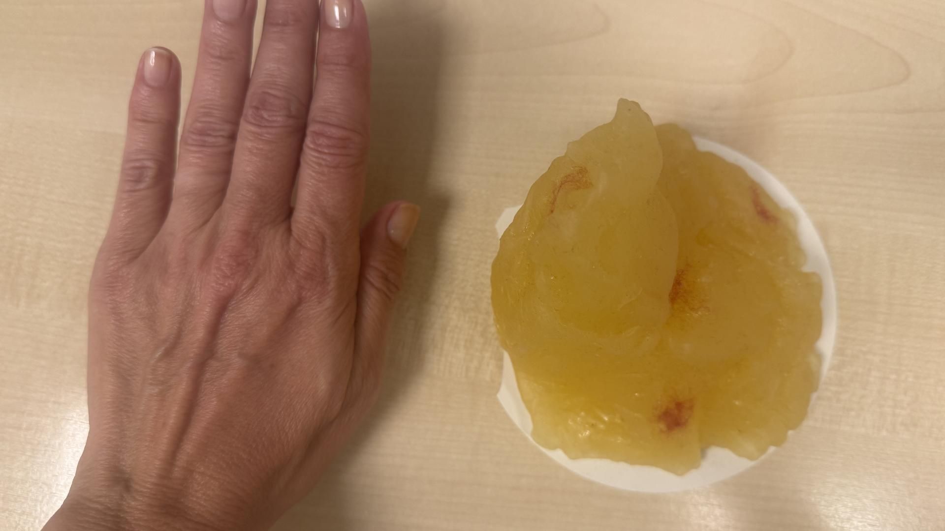 Grasa visceral comparada con una mano