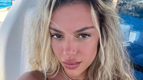 Alejandra Rubio enseña las secuelas que tiene en la cara por no usar