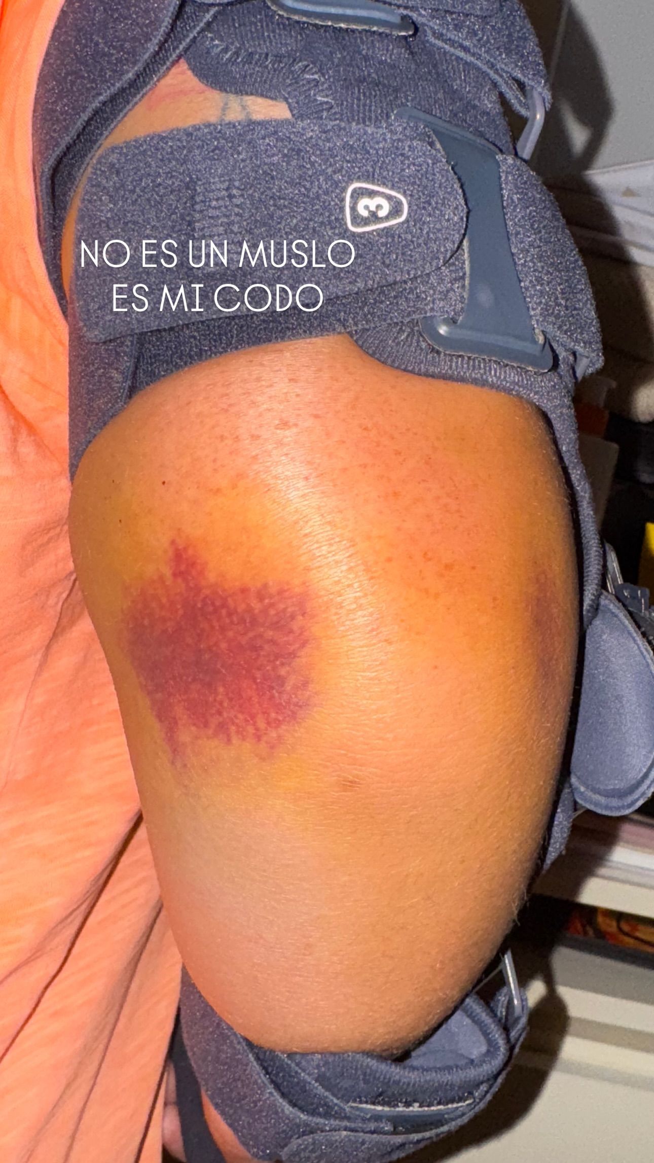 Anabel Pantoja enseña su codo hinchado y amoratado tras su caída