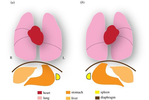 Situs solitus vs situs inversus