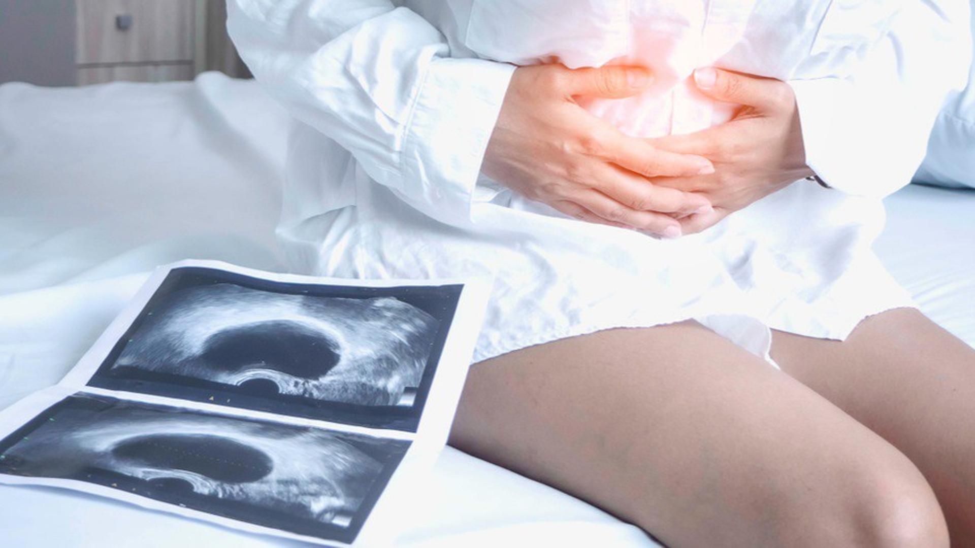 Archivo - Endometriosis